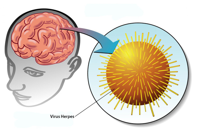 Ảnh 3 của Viêm não Herpes